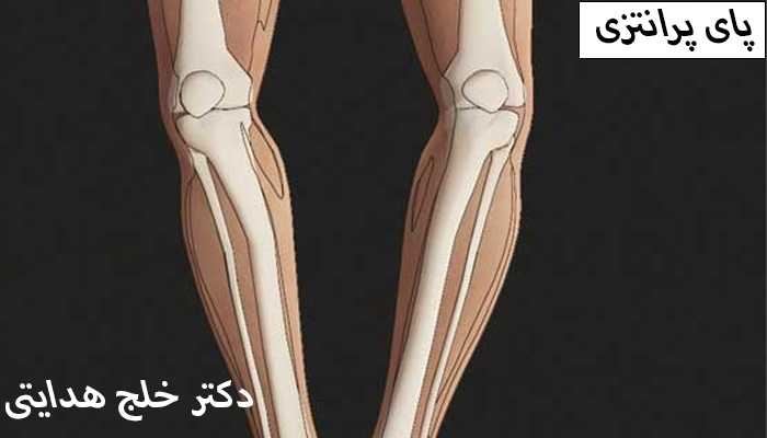 اهمیت زمان تشخیص پای پرانتزی