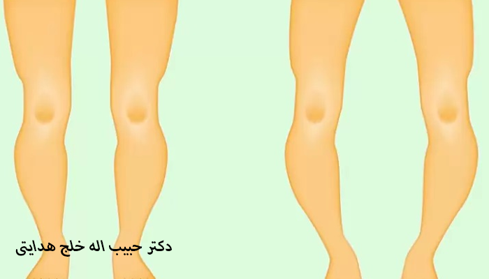 علت پای پرانتزی