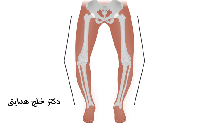 عوارض پای پرانتزی