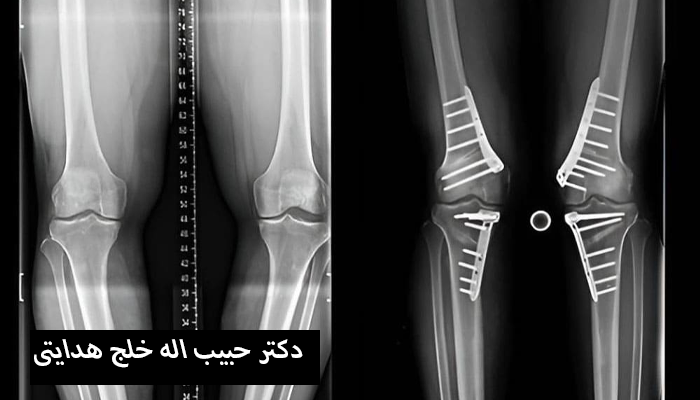 مزایای درمان پای پرانتزی