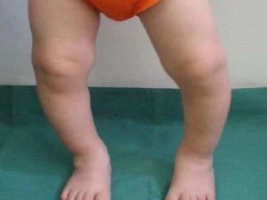 پای پرانتزی