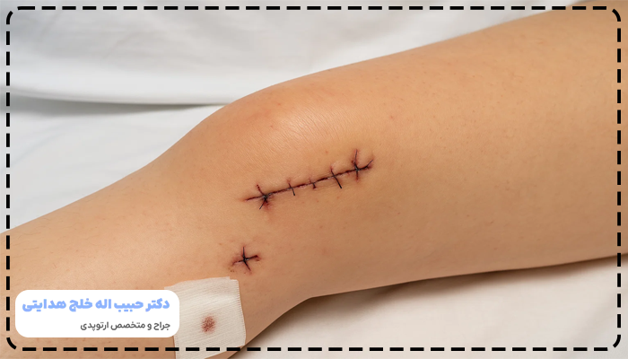 جراحی مینیسک زانو چیست
