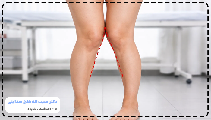 زانوی ضربدری چیست
