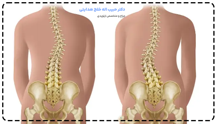 انحراف ستون فقرات چیست