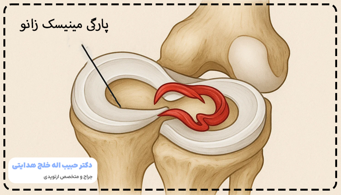 ایا پارگی مینیسک زانو ترمیم میشود