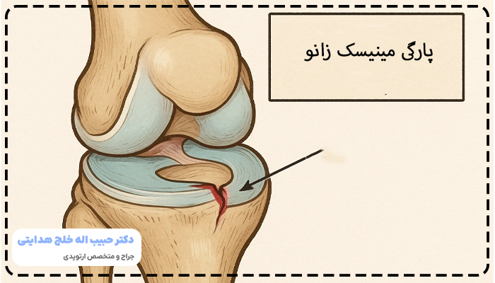 پارگی مینیسک زانو چیست؟