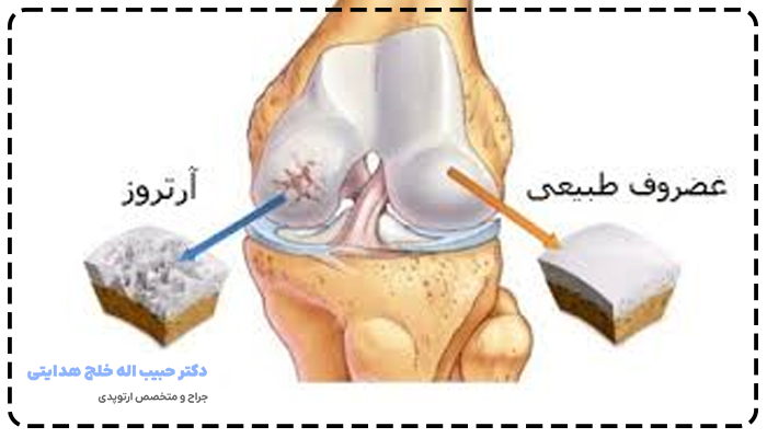 آرتروز چیست
