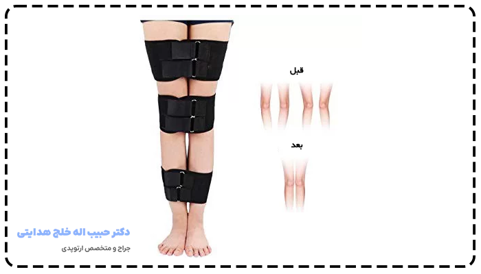 انواع درمان پای ضربدری