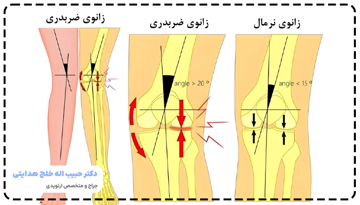 درمان زانوی ضربدری
