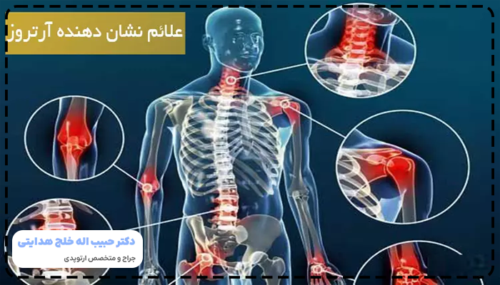 علائم آرتروز