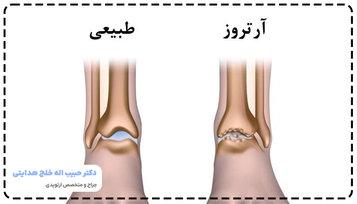 علت آرتروز