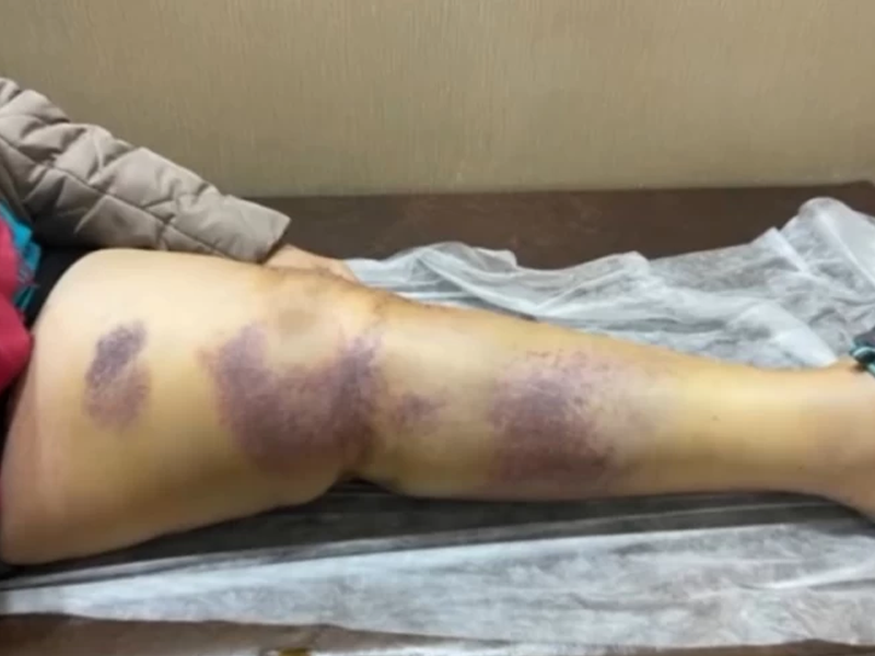 لخته شدن خون بعد تعویض مفصل زانو