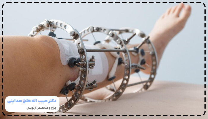 الیزاروف چیست