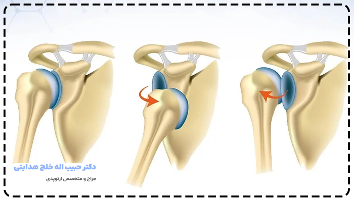 در رفتگی مفصل شانه