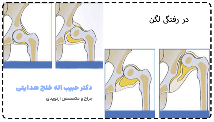 در رفتگی مفصل لگن