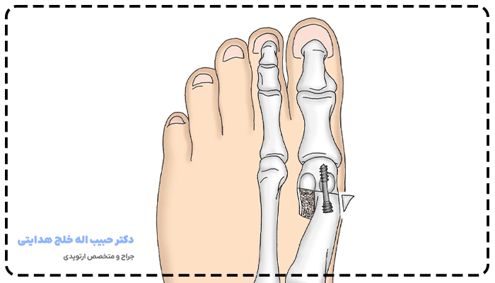 درمان هالوکس والگوس