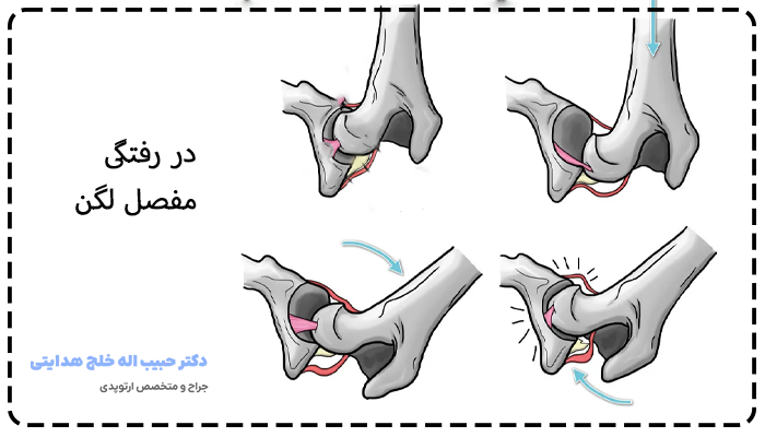 علائم در رفتگی لگن