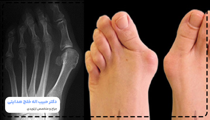 علت هالوکس والگوس
