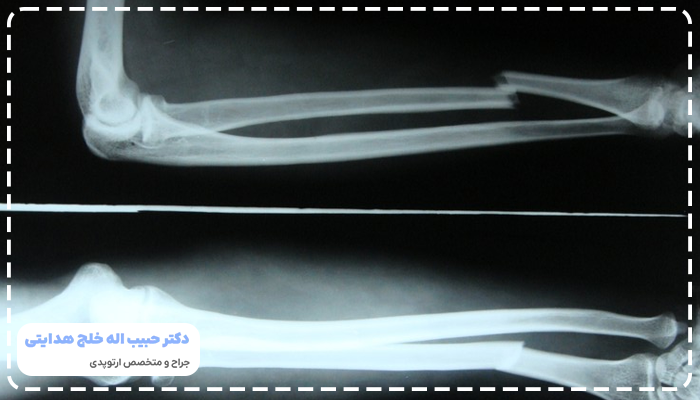 عوارض عدم درمان شکستگی استخوان