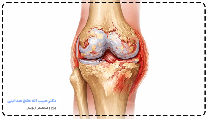 قرص برای درمان آرتروز