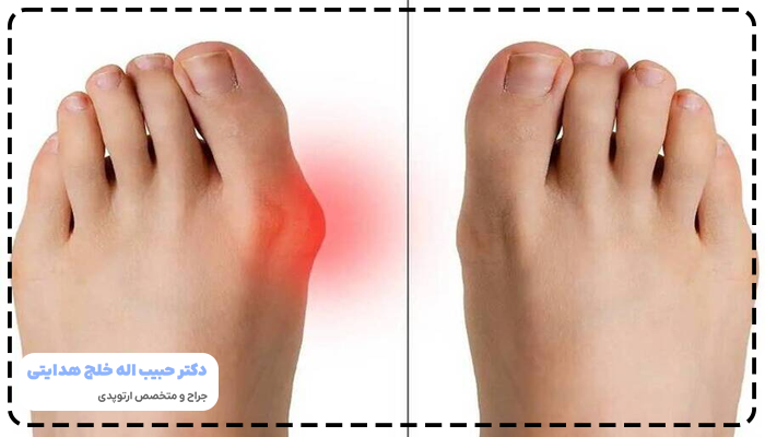 هالوکس والگوس چیست