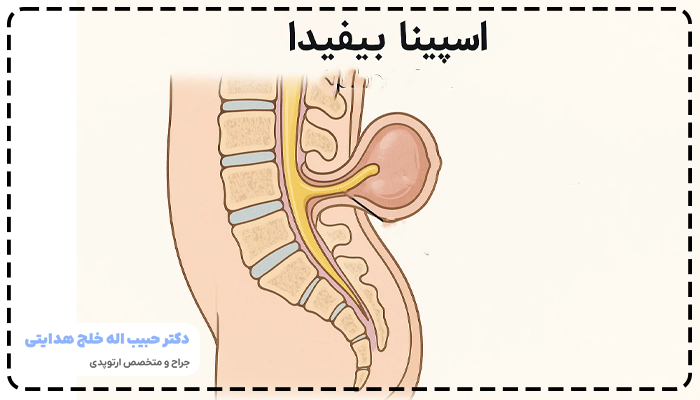 اسپینا بیفیدا (Spina Bifida)