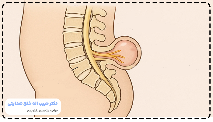 اسپینا بیفیدا