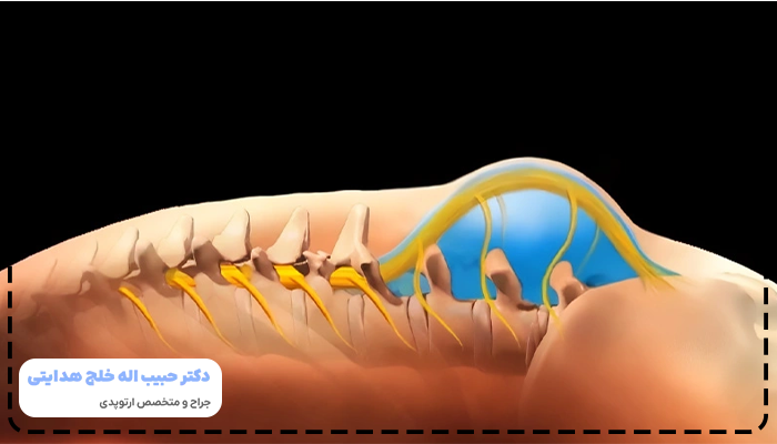 درمان اسپینا بیفیدا