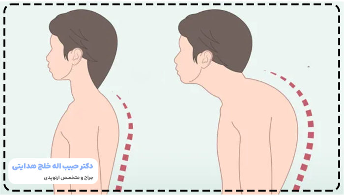 کیفوز